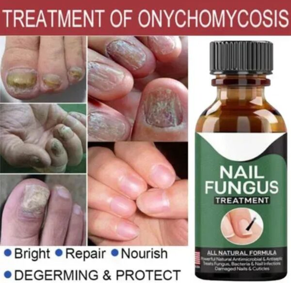 Fast Nail Fungal Treatment Serum